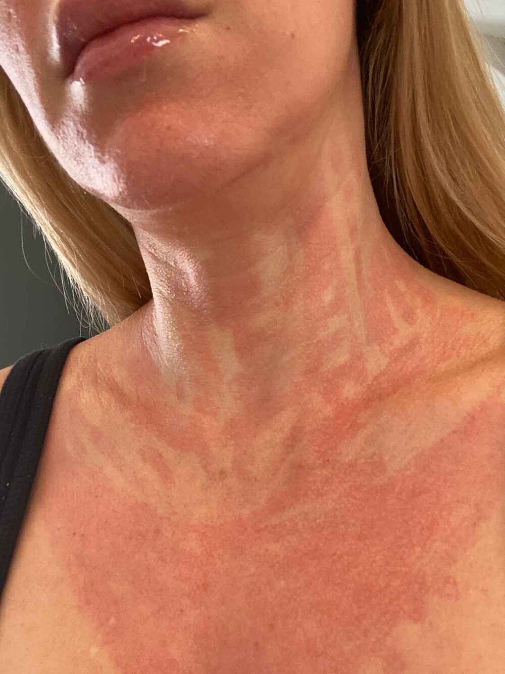 micro needling side effects redness after womans neck