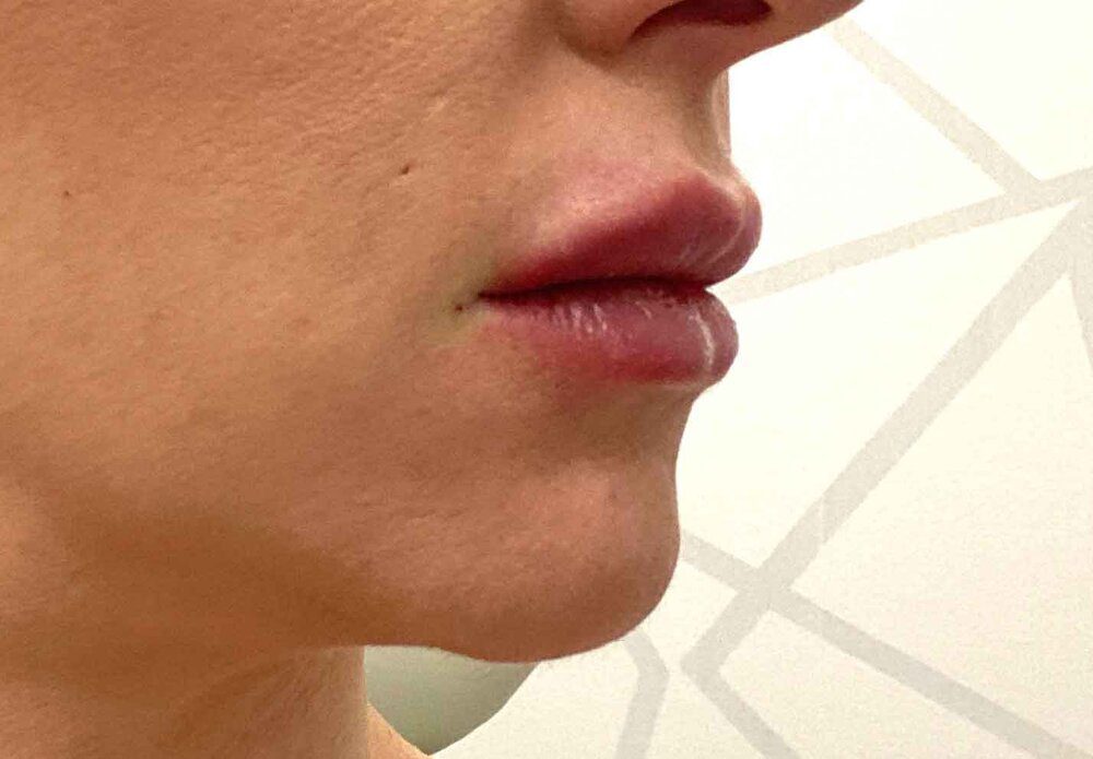Lip injectable treatment after Eve Dawes