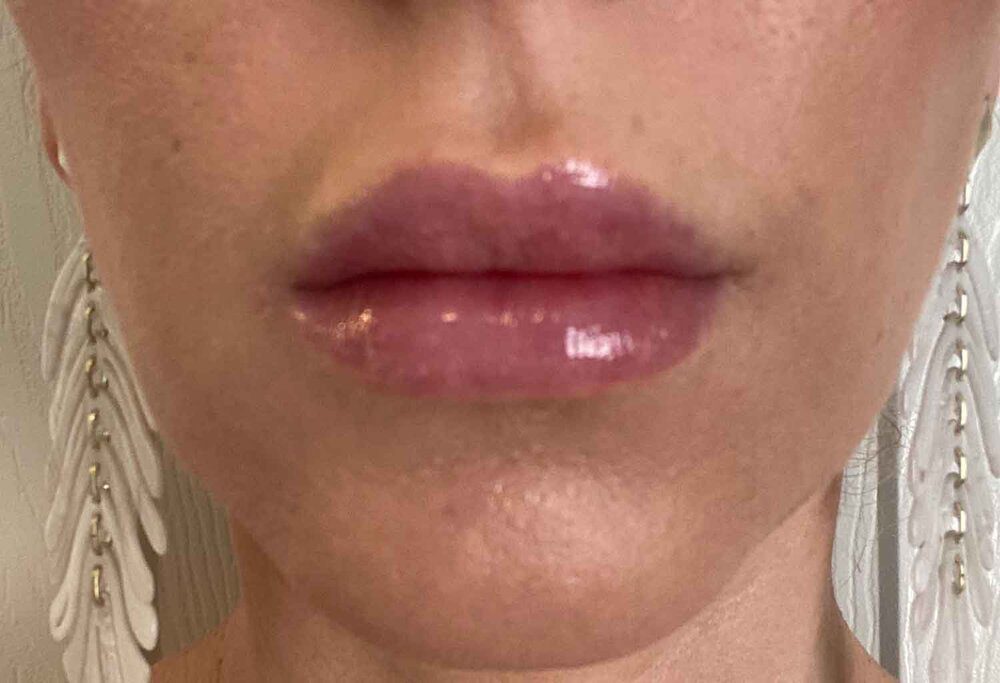 Lip filler close up after photo Eve Dawes Vegas
