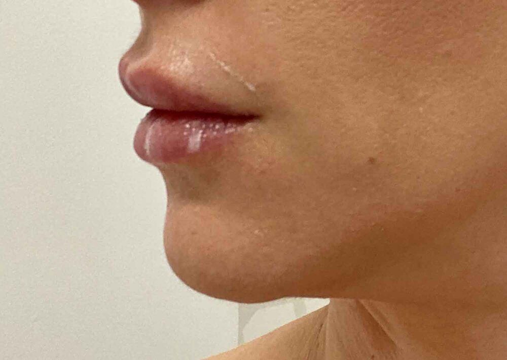 Lip filler before KISS injectable photo