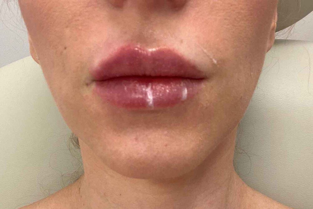 Lip filler mid treatment before and after Eve Dawes