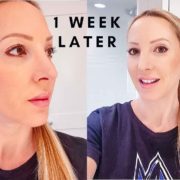 microneedling before after beauty blogger