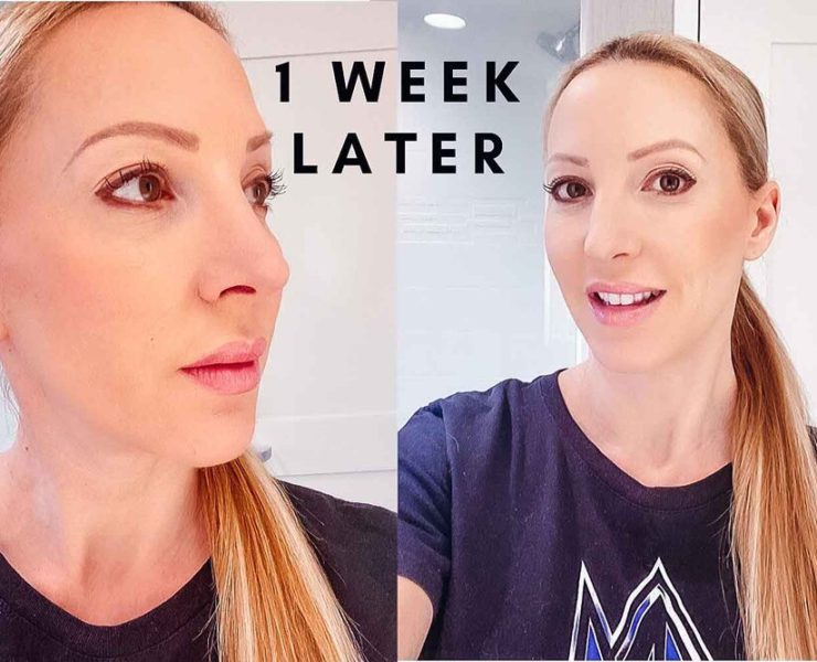 microneedling before after beauty blogger