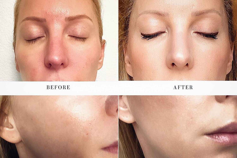 Collagen induction therapy results before after eve dawes