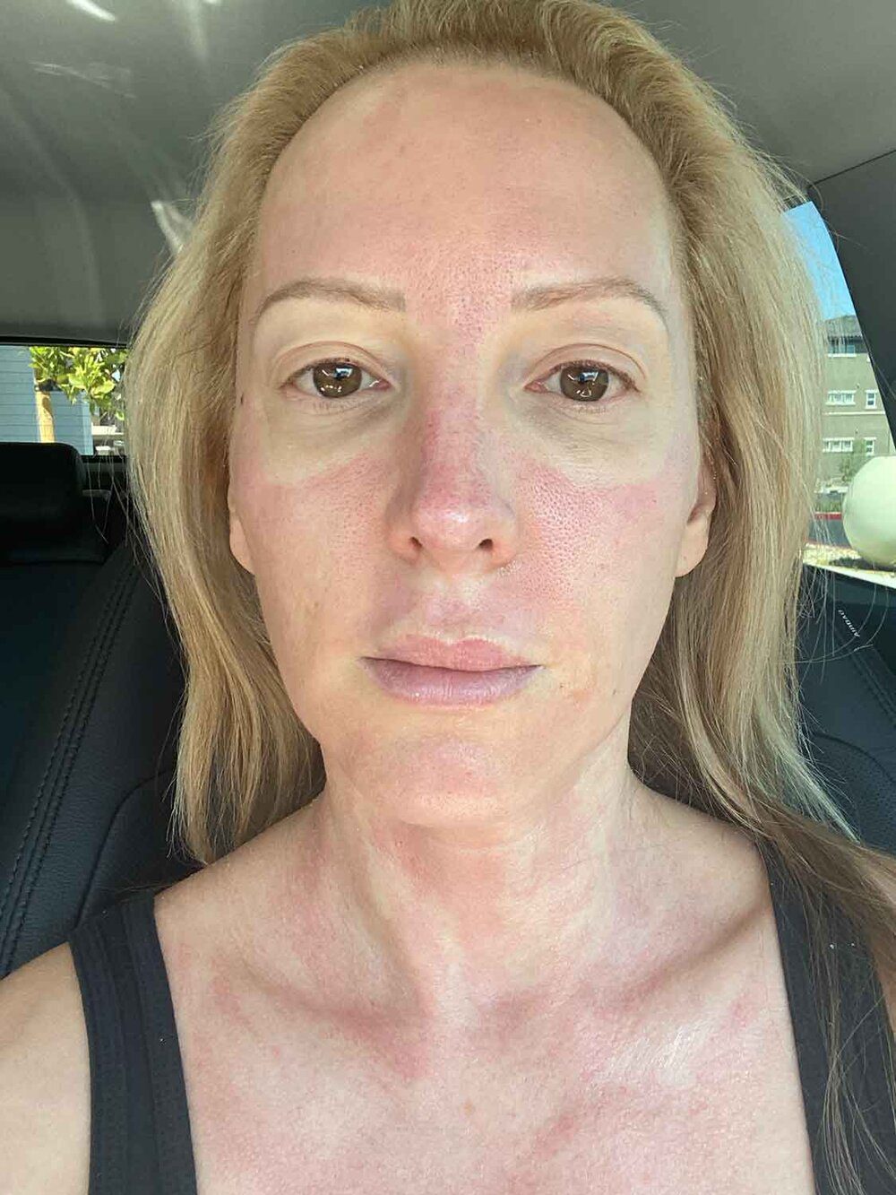 Beauty blogger Eve Dawes red face side effect after microneedling treatment