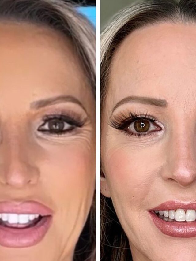 Everything You Need to Know About Radiofrequency Microneedling