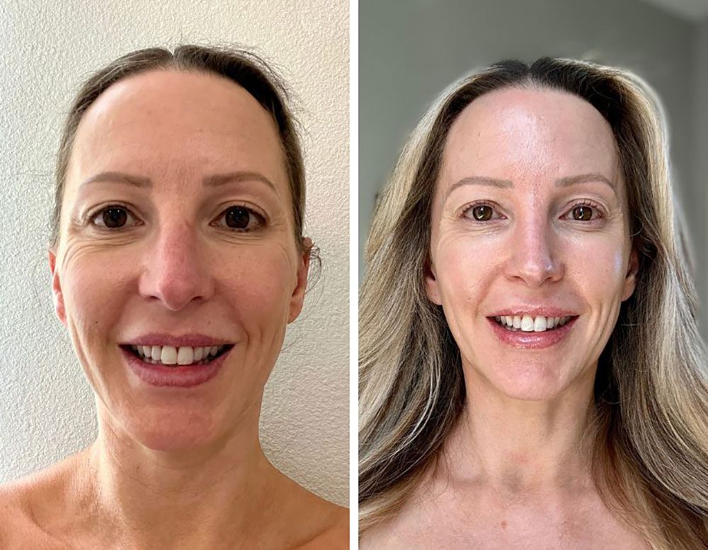 RF microneedling before after