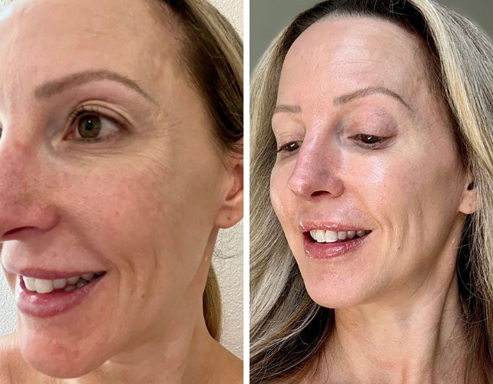 microneedling radiofrequency before after