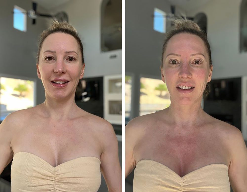 Before and redness rimmediately after microneedling with radiofrequency