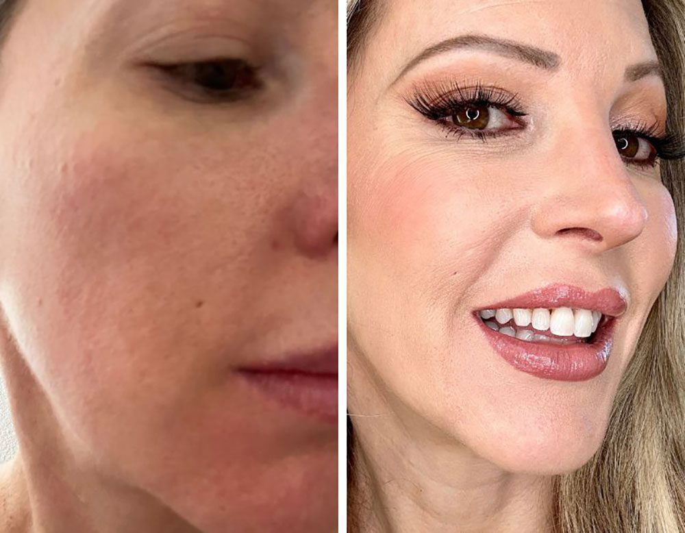 RF microneedling before after results scars pores