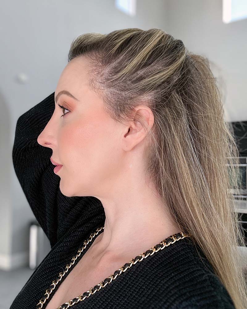 hair loss woman scalp