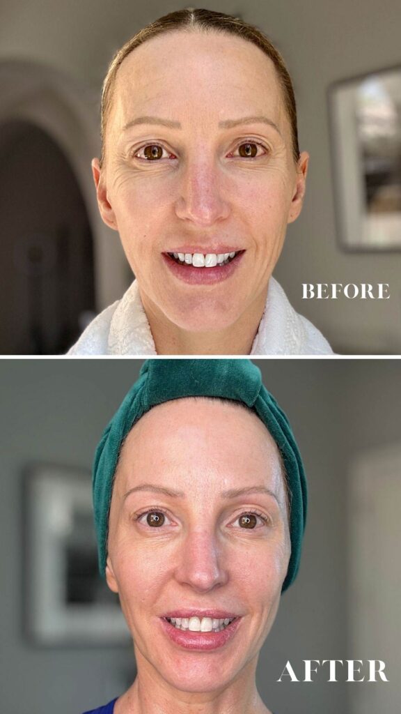 ziip halo before after results 6 months woman