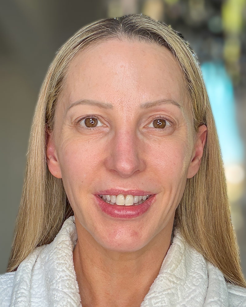 banish at home microneedling results