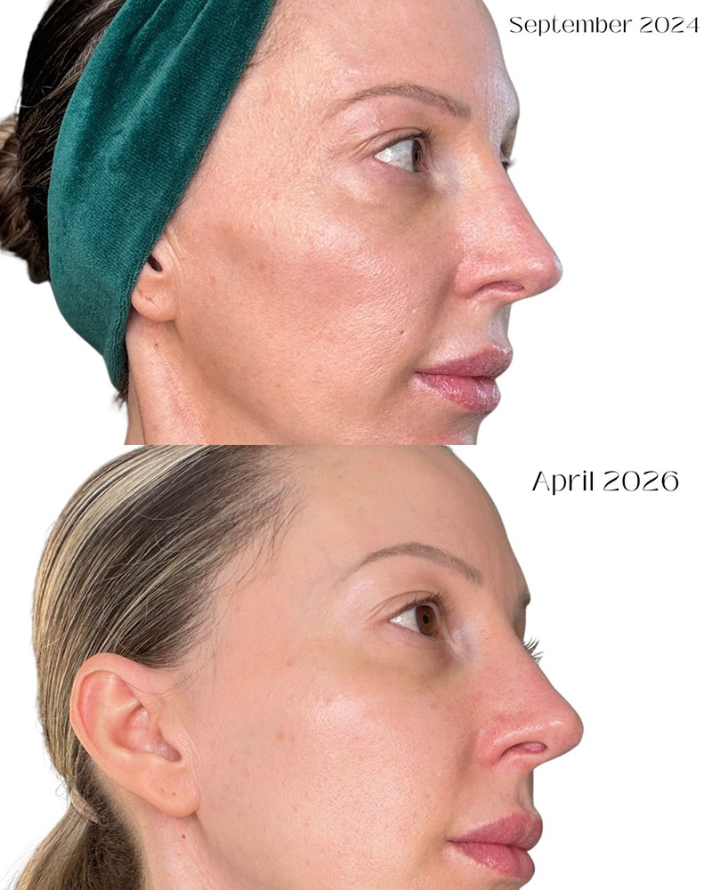 microneedling at home results before after Banish 3.0