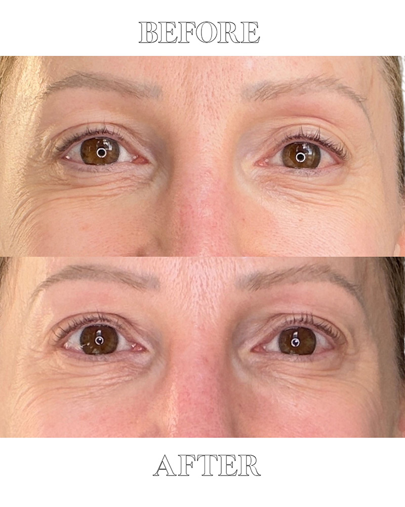 Dr Diamond Metacine before after eyes crows feet