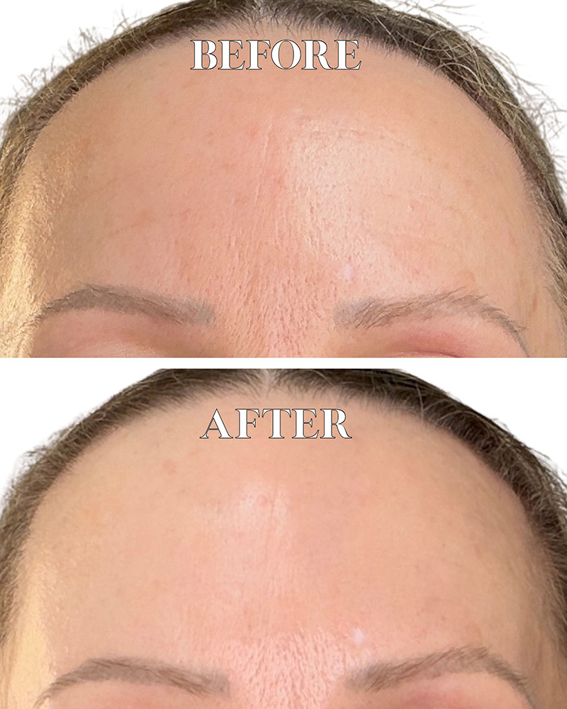 Dr Diamond Metacine before after results forehead