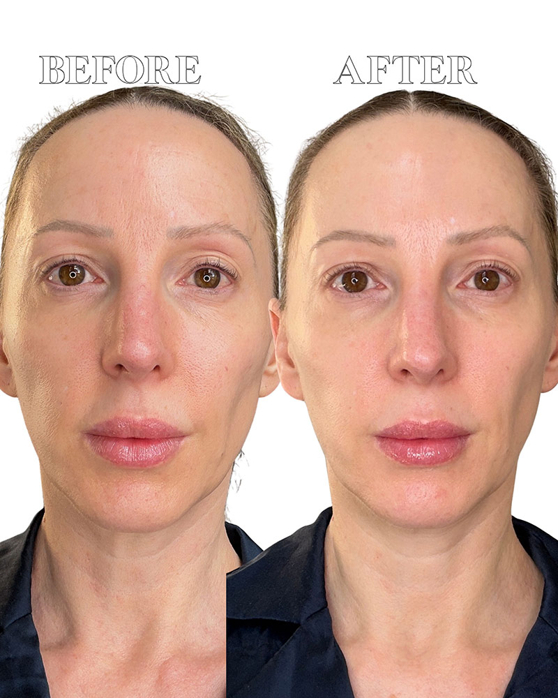 Dr Diamond Metacine before and after