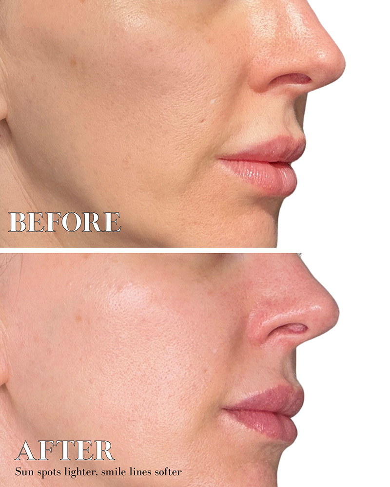 Dr Diamond Metacine before after smile lines