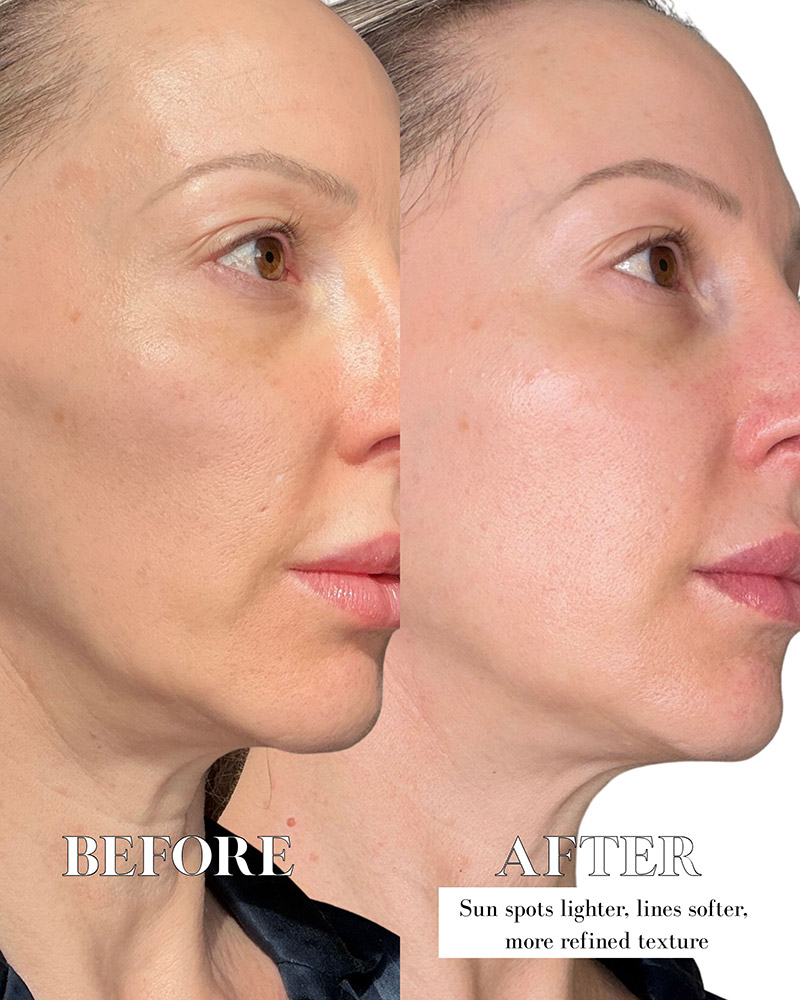 Dr Diamond Metacine before and after sun spots pores