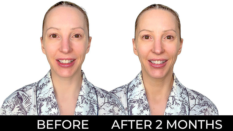 Dr Diamond's Metacine Instafacial Infusion before and after results