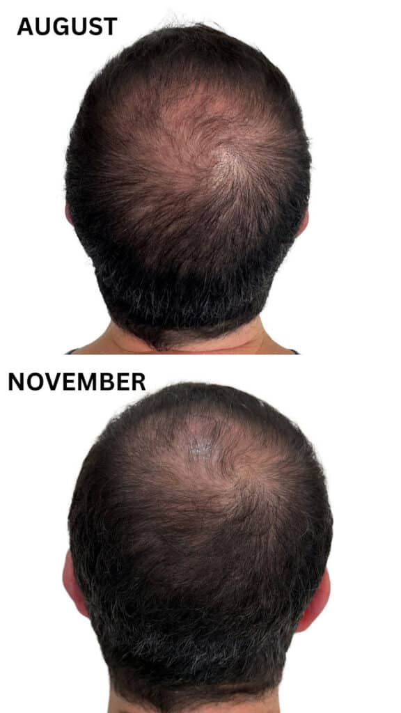 before after man OneSkin OS-01 Hair Peptide Scalp Serum