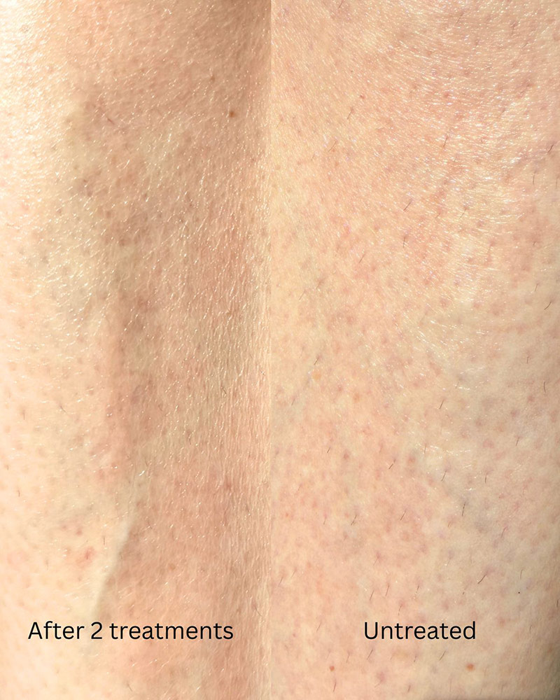 Tria Laser Hair Removal Home Before After Legs Legs
