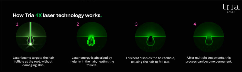 How Tria laser hair removal works in home devices