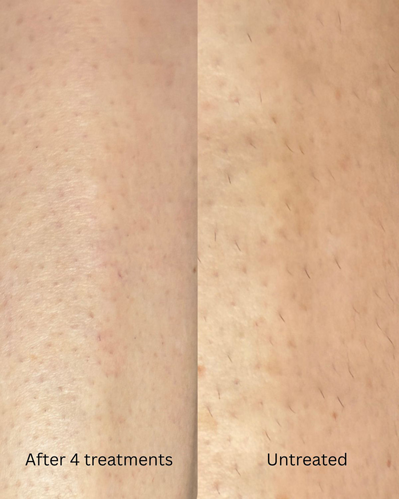 laser hair removal permanent tria before after results legs