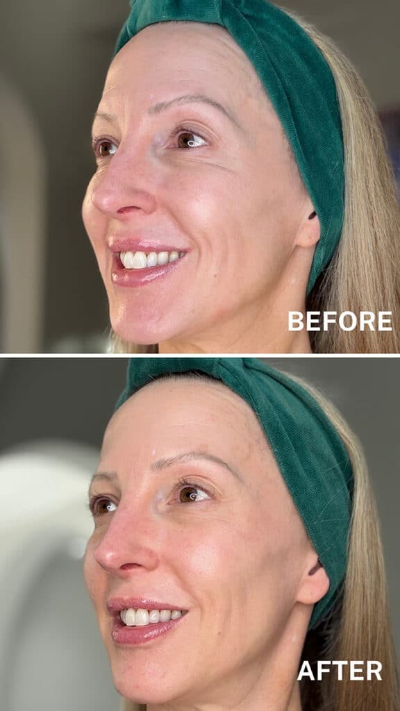 red light therapy fine lines before and after results currentbidy