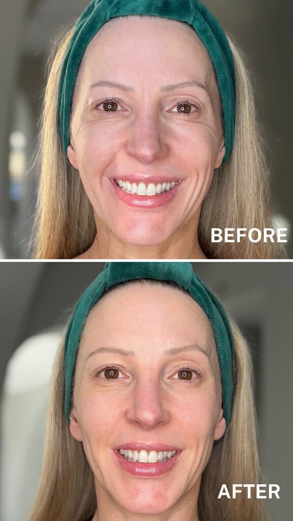 Currentbody led mask before and after results eve dawes