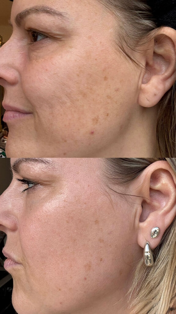 Current body LED mask before and after