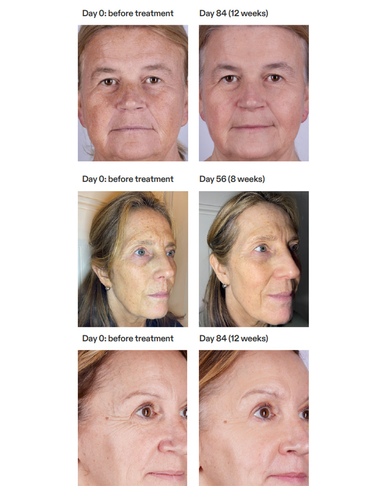 Current body LED mask face before and after