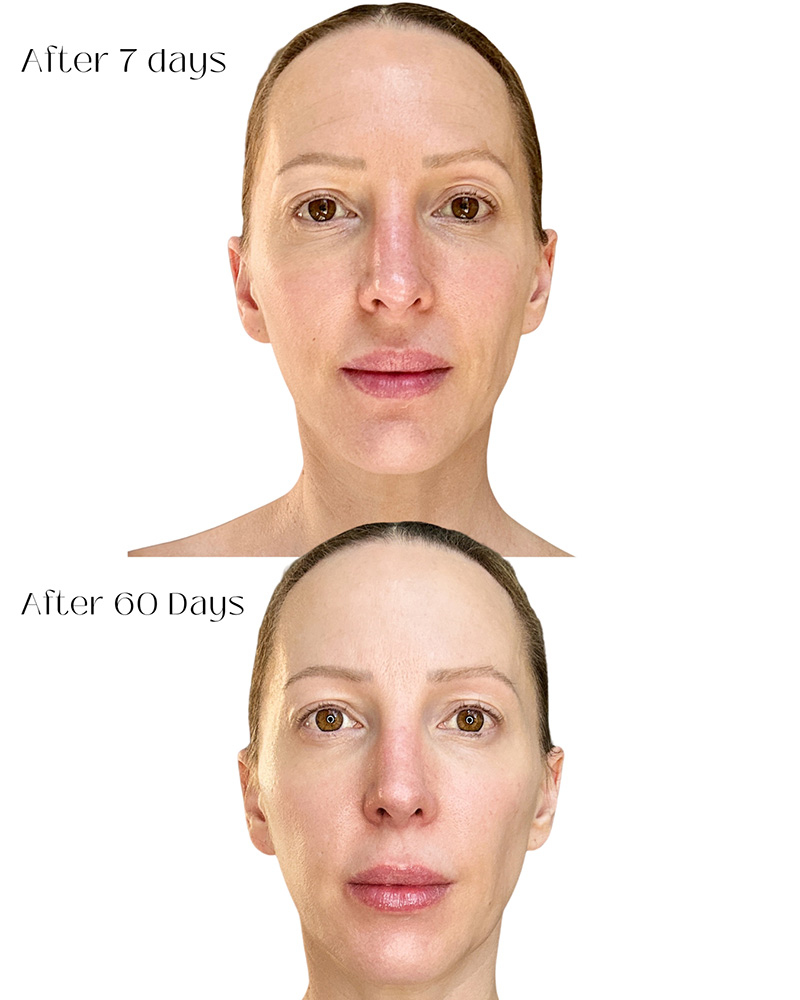 nuface results before after