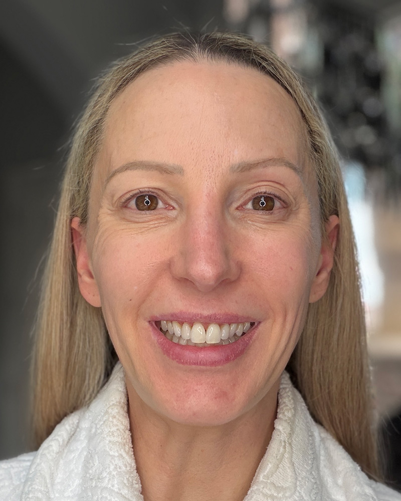 dr diamonds eyelift before after