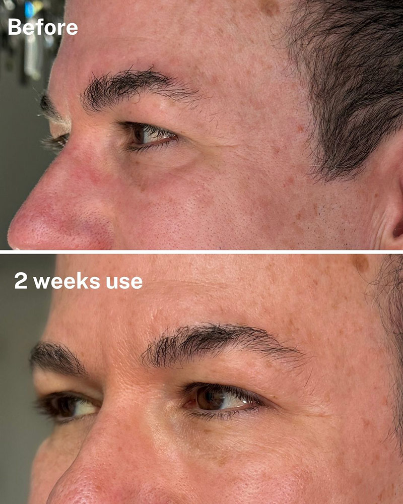dr diamonds eyelift mens before after results