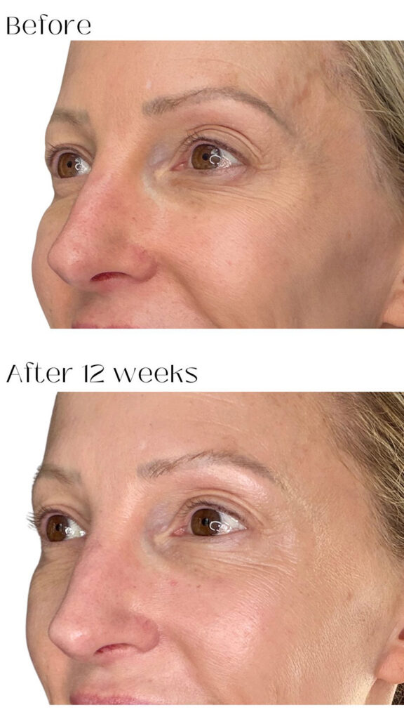 Dr Diamond's Contour Collection Eyelift results 12 week before and after photos