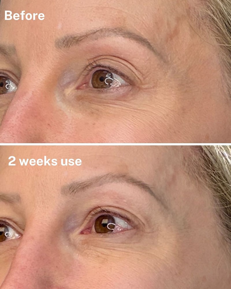 dr diamonds eyelift results upper lid hooded eyes