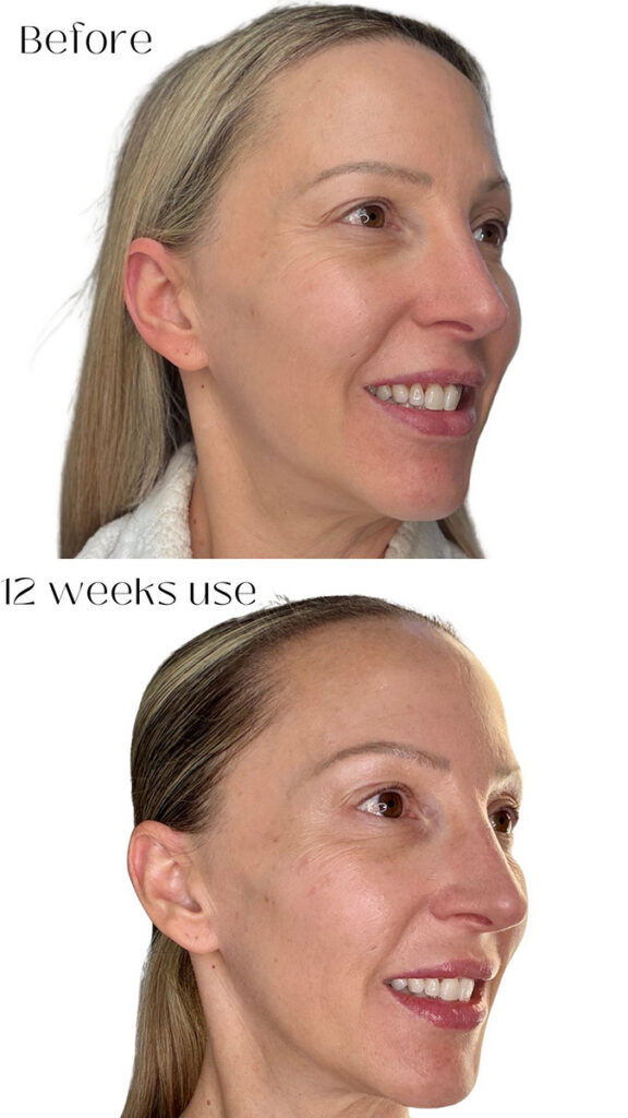 Dr Diamond's Contour Collection Eyelift results woman after 12 weeks use