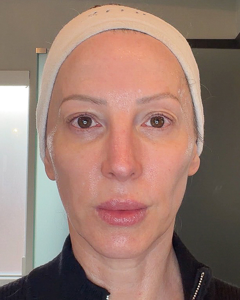 ZIIP Halo 2.0 before and after results skin lifting tightening