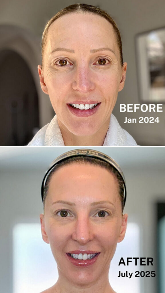 ziip halo before after results long term