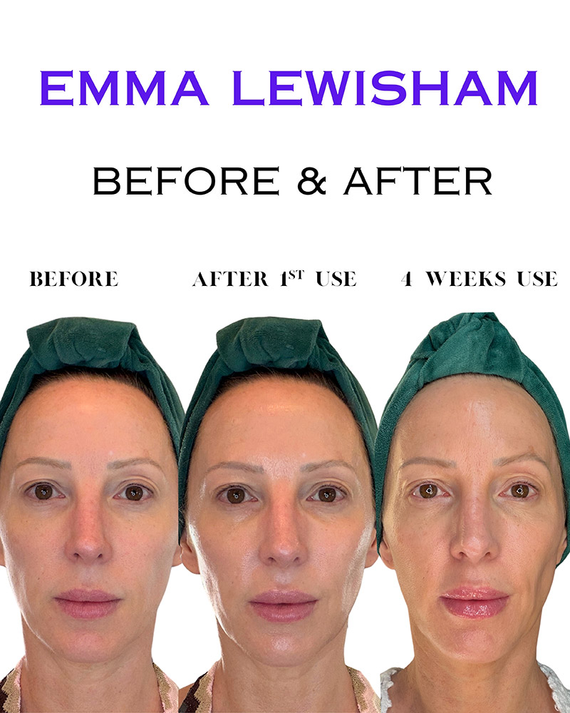 emma lewisham review before and after result photo comparisons woman in late forties