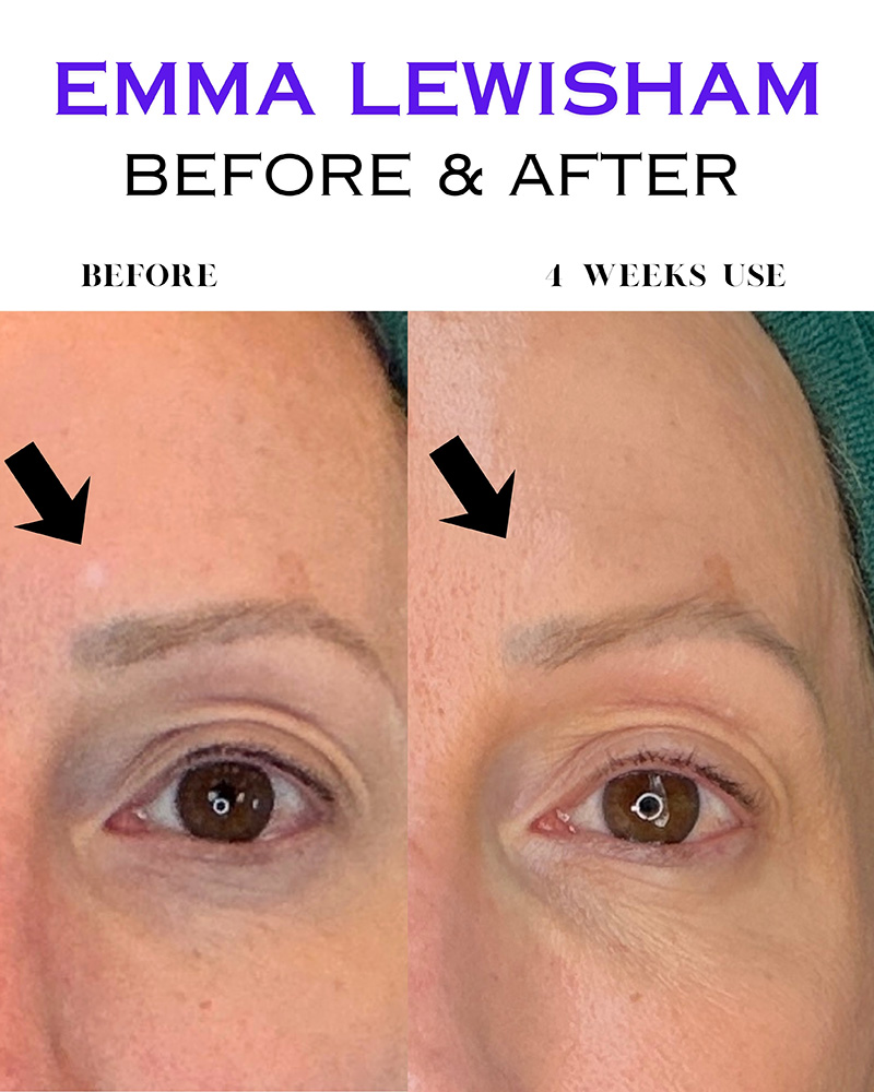 emma lewisham vitale elixir review before after results close up of a woman's forehead