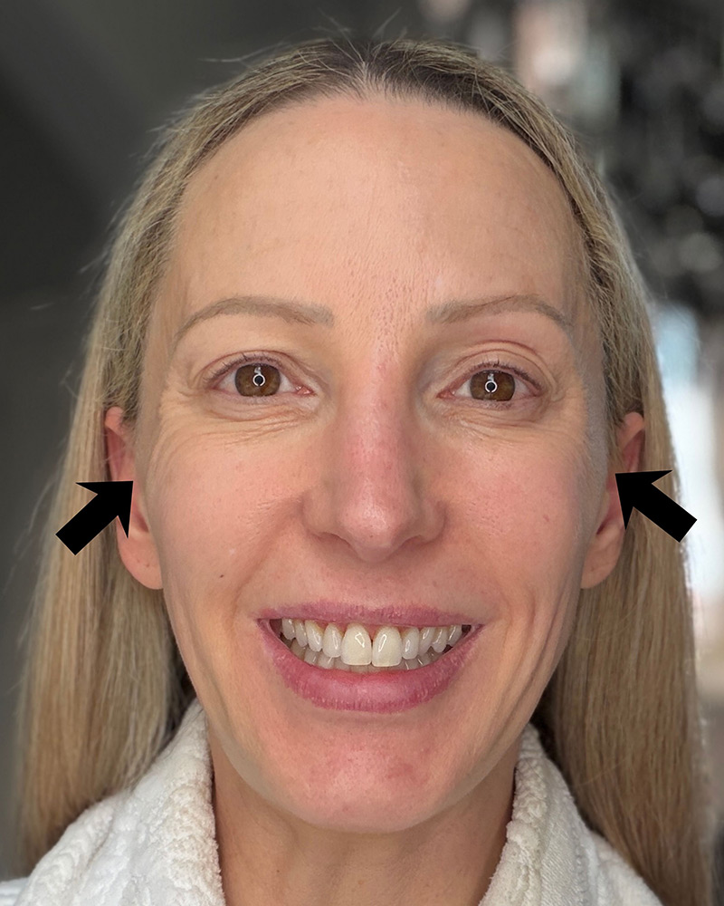 at home fractional laser before photo of crows feet