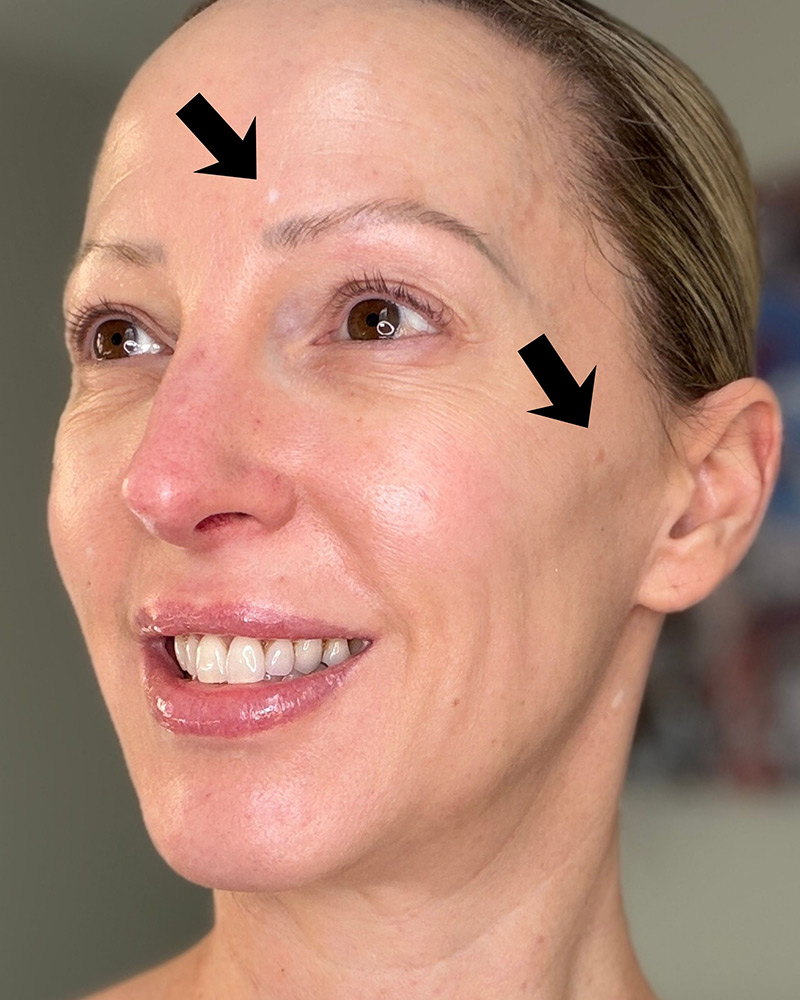 at home fractional laser treatment sun spot and scar before
