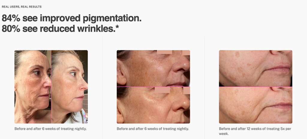 fractional laser at home results from Tria FRX