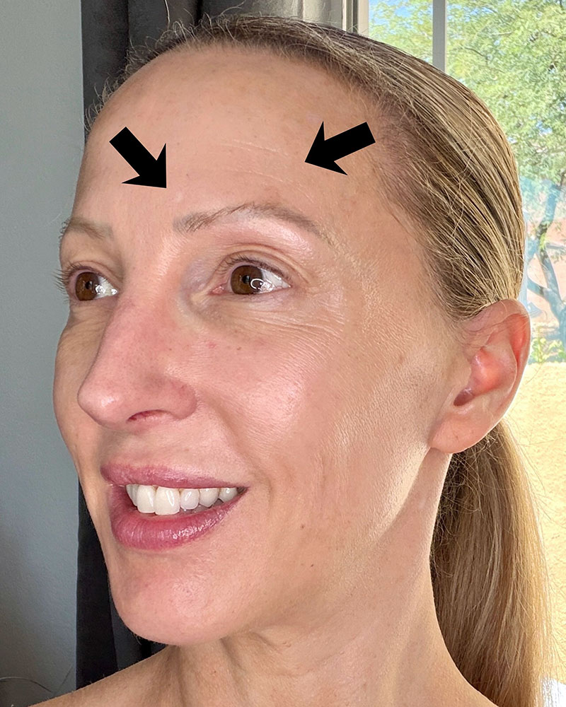 fractional laser at home treatment wrinkles before