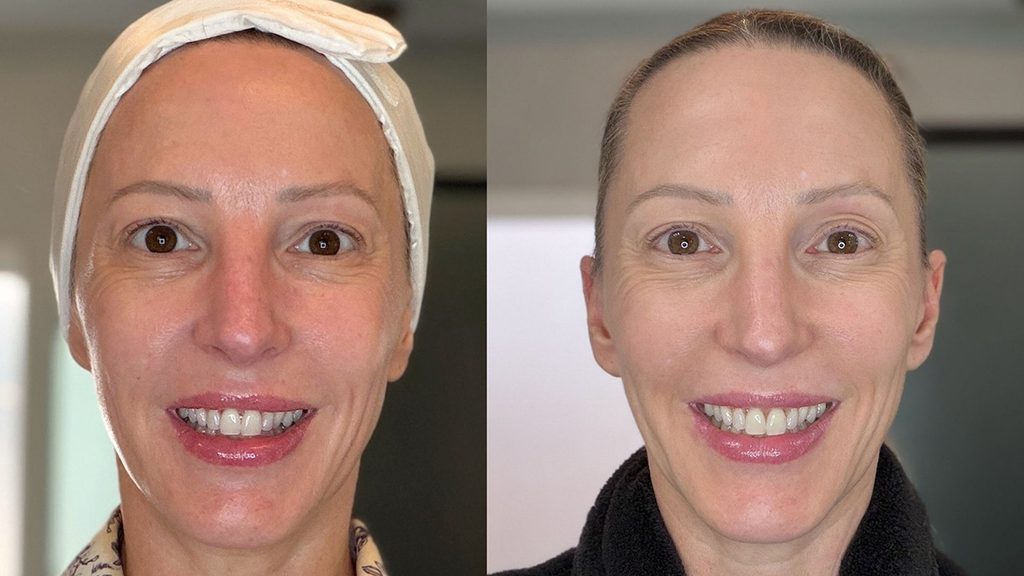 Tria FRX at home fractional laser before and after photos