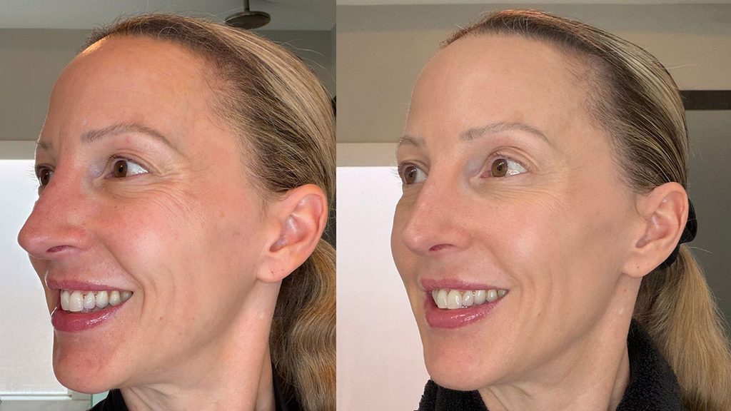 tria frx review before and after results crows feet and skin color