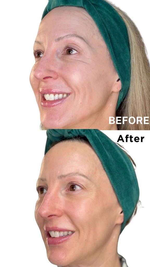 currentbody led mask series 3 before and after results on fine lines and wrinkles